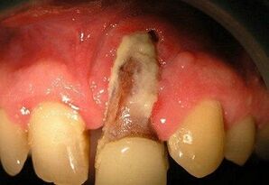 osteomyelitis fogkivonás után